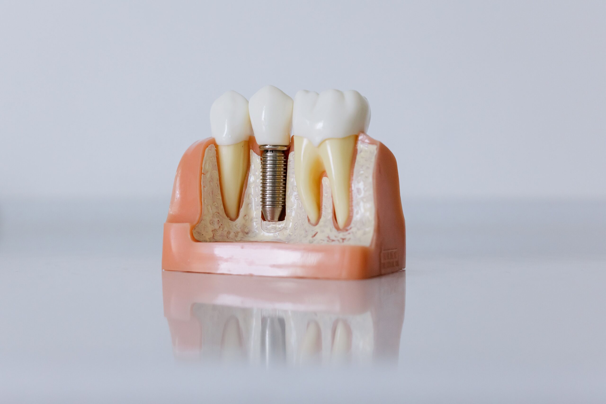 Our Services Detailed dental implant model showcasing teeth structure for educational purposes.
